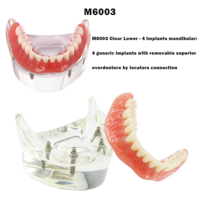 Planets Dental Implant Practice Models