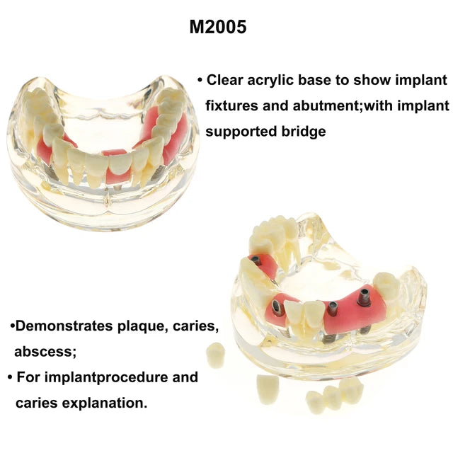 Planets Dental Implant Practice Models