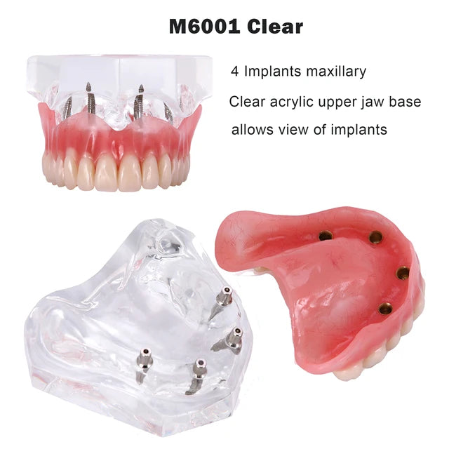 Planets Dental Implant Practice Models