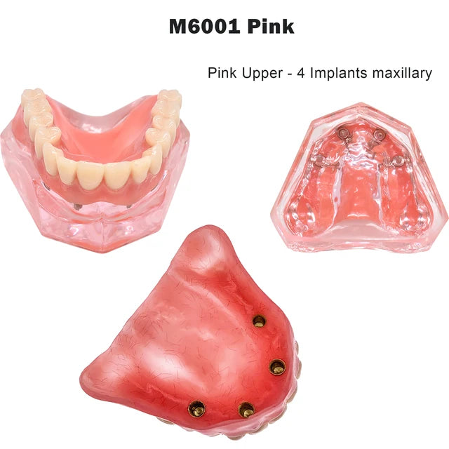 Planets Dental Implant Practice Models