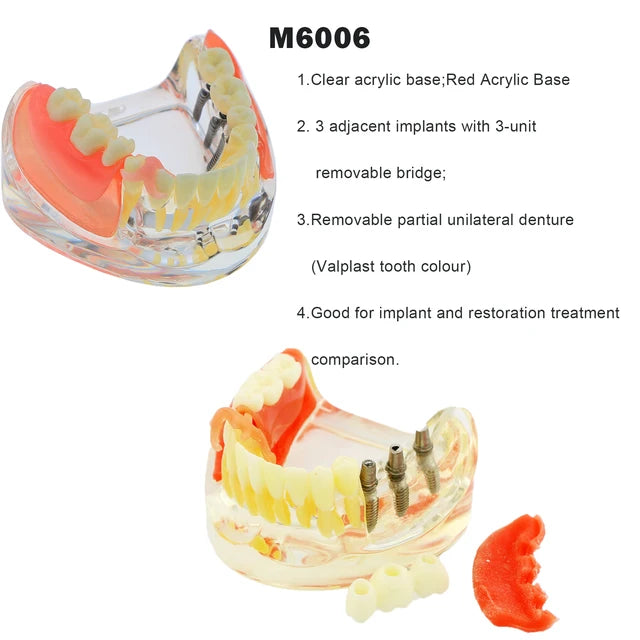Planets Dental Implant Practice Models