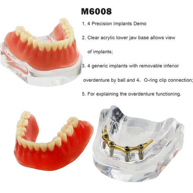 Planets Dental Implant Practice Models
