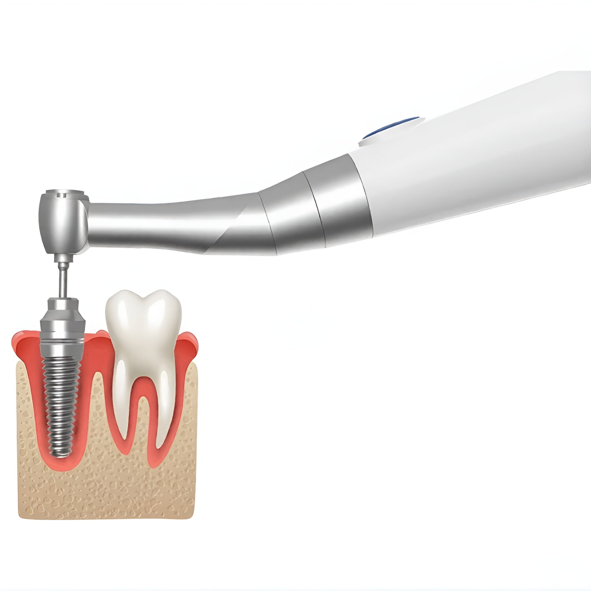 Motor X – Cordless Electric Dental Torque Driver