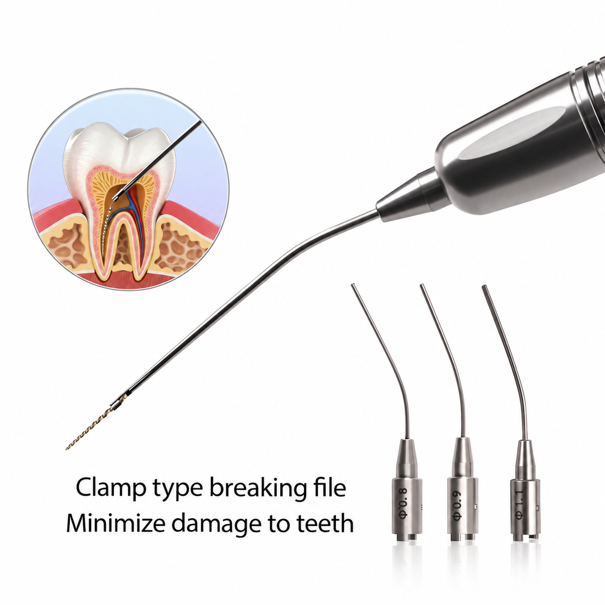 Endodontic Broken File Removal System