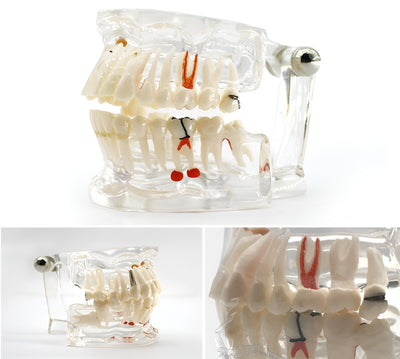 Dental Education Model (Patholigical)
