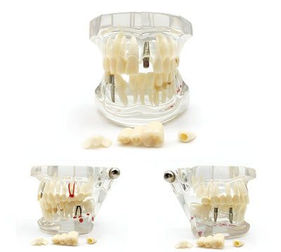 Dental Education Model (Implant Restoration)