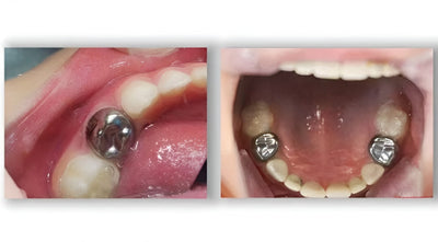 Stainless Steel Primary Molar Crowns